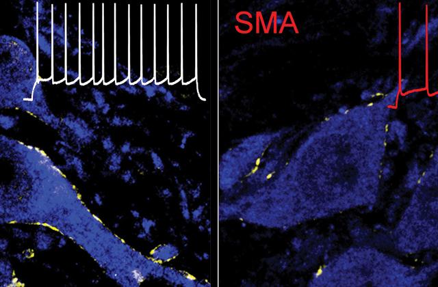 Spinal Muscular Atrophy