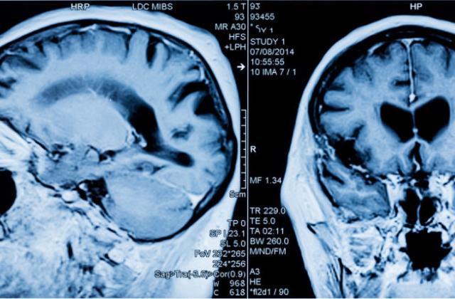 MRI head scan