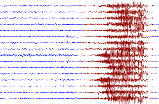 EEG Neurofeedback